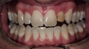 a close up front view of a patient's teeth with bad oral health conditions