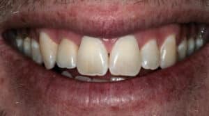 a close up view of a patient's teeth after receiving orthodontic treatment