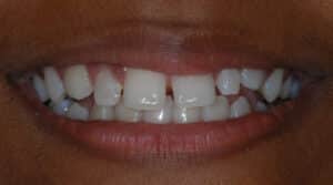a close up of a patient's teeth with spacing in between the teeth