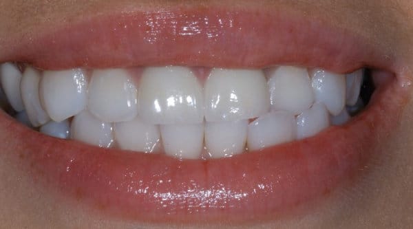 front view of patient Garcia's teeth after receiving orthodontic treatment
