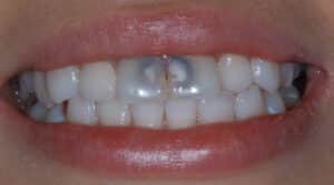 a close up of a patient's teeth with an orthodontic condition
