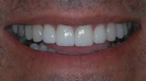front view of a patient's teeth after receiving orthodontic treatment