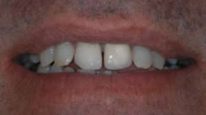 a close up of a patient's mouth with minimal spacing in the front