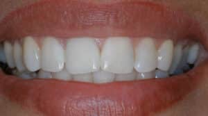 a front view of teeth with porcelain crowns 