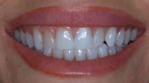 a close up of teeth to show the end result of porcelain veneer treatment