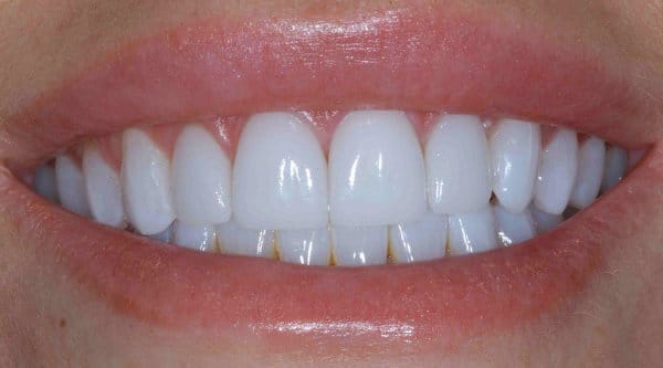 a close up of teeth with porcelain upper veneers