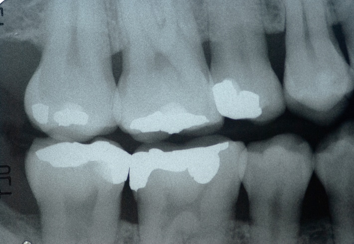 dental x-rays of a patient's mouth used before orthodontic treatment