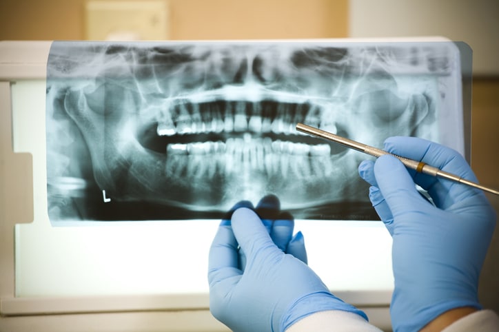 Dental professional examing a patient x ray, pointing to a tooth in the top right quadrant