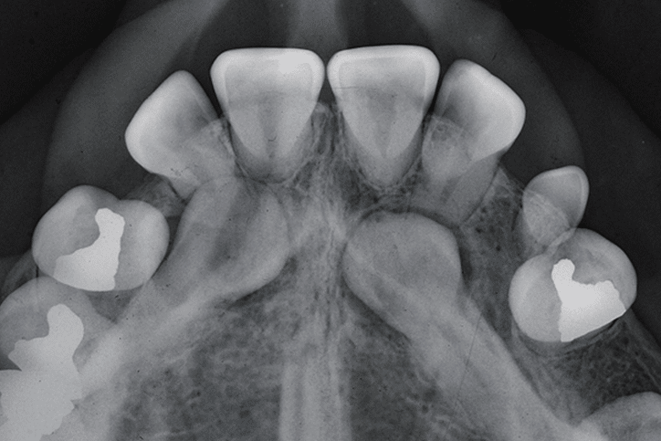 a patient's dental x-ray of the top of the mouth