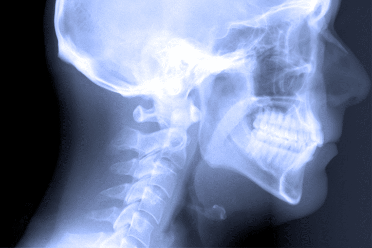 side x-ray image of a patient with occlusion of the teeth 
