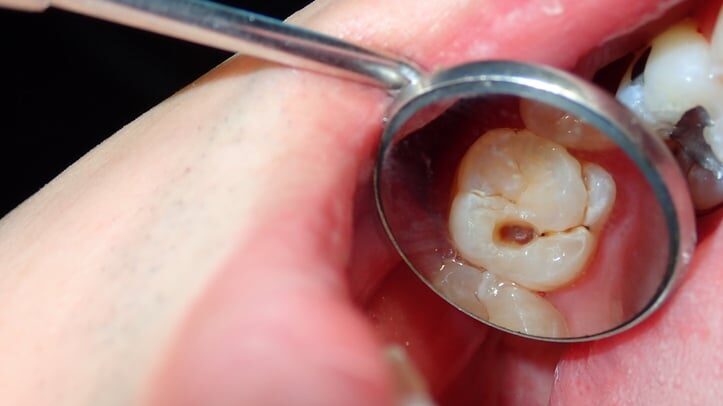 Magnifying glass revealing a missing filling on a patient's molar
