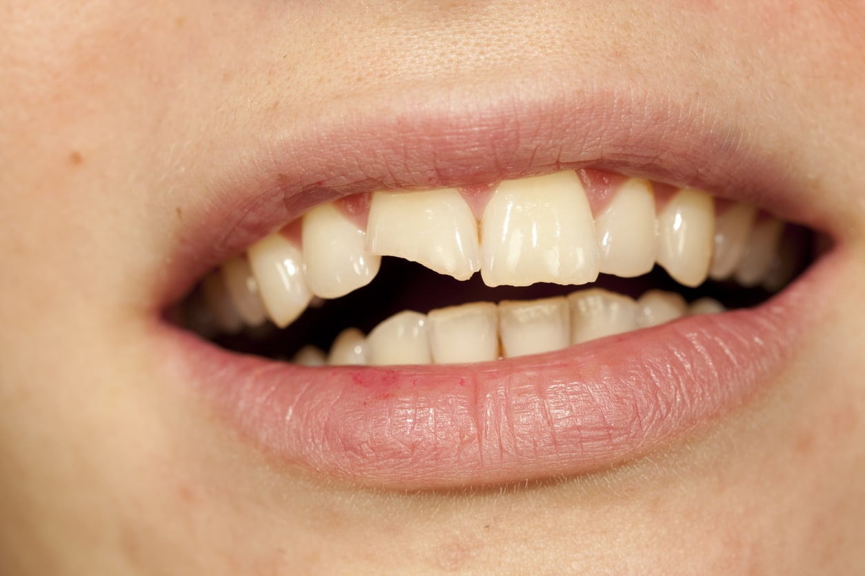 A closeup image of a smile with a chipped tooth