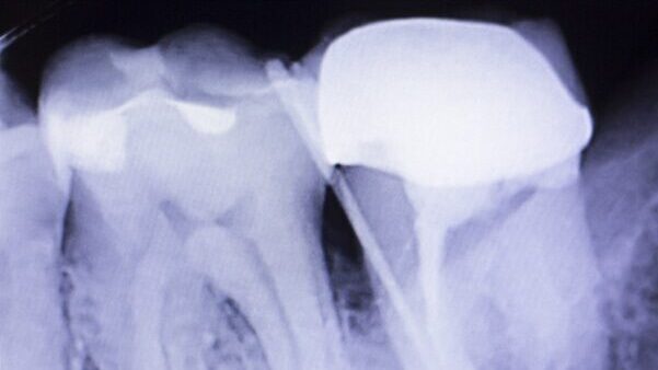 A dental x-ray showing an intense white cap over a patient's tooth