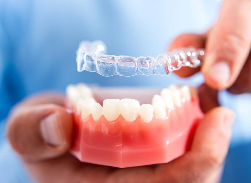 Close up of a clear aligner tray going over a dental model