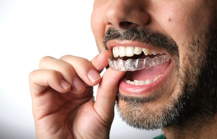 Middle aged man inserting a clear aligner tray onto his top teeth