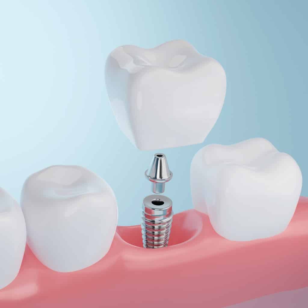 3-D illustration showing titanium posts that replace the root of a tooth during dental implants