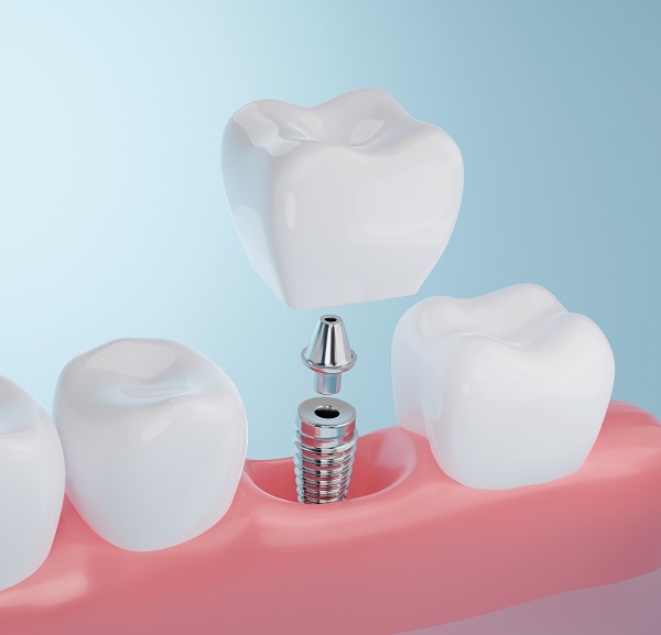 3-D Illustration showing titanium posts that replace the root of a tooth