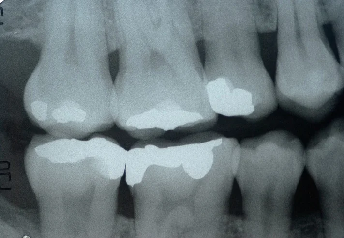 dental x-rays of a patient's mouth used before orthodontic treatment