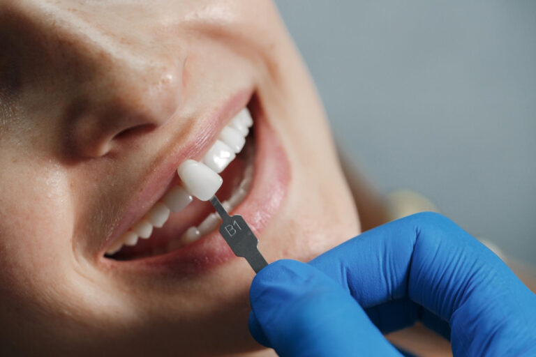 dentist placing dental veneer