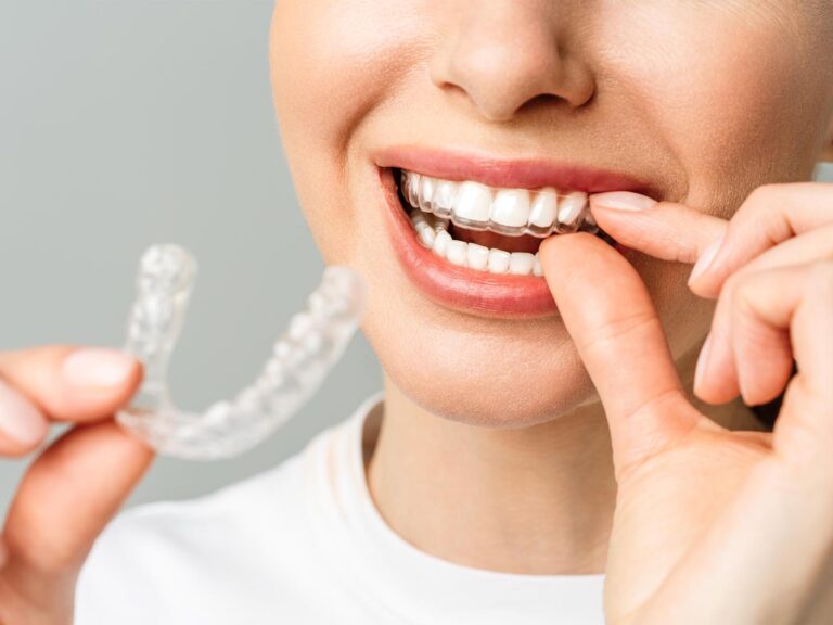 Invisalign Frequently Asked Questions at Pathway Dental Group