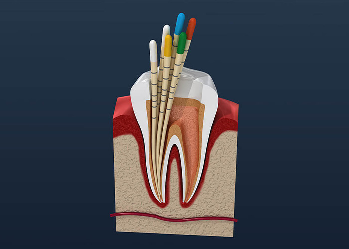 Cross-sectional view of a tooth with dental files inserted, showing a root canal treatment procedure.