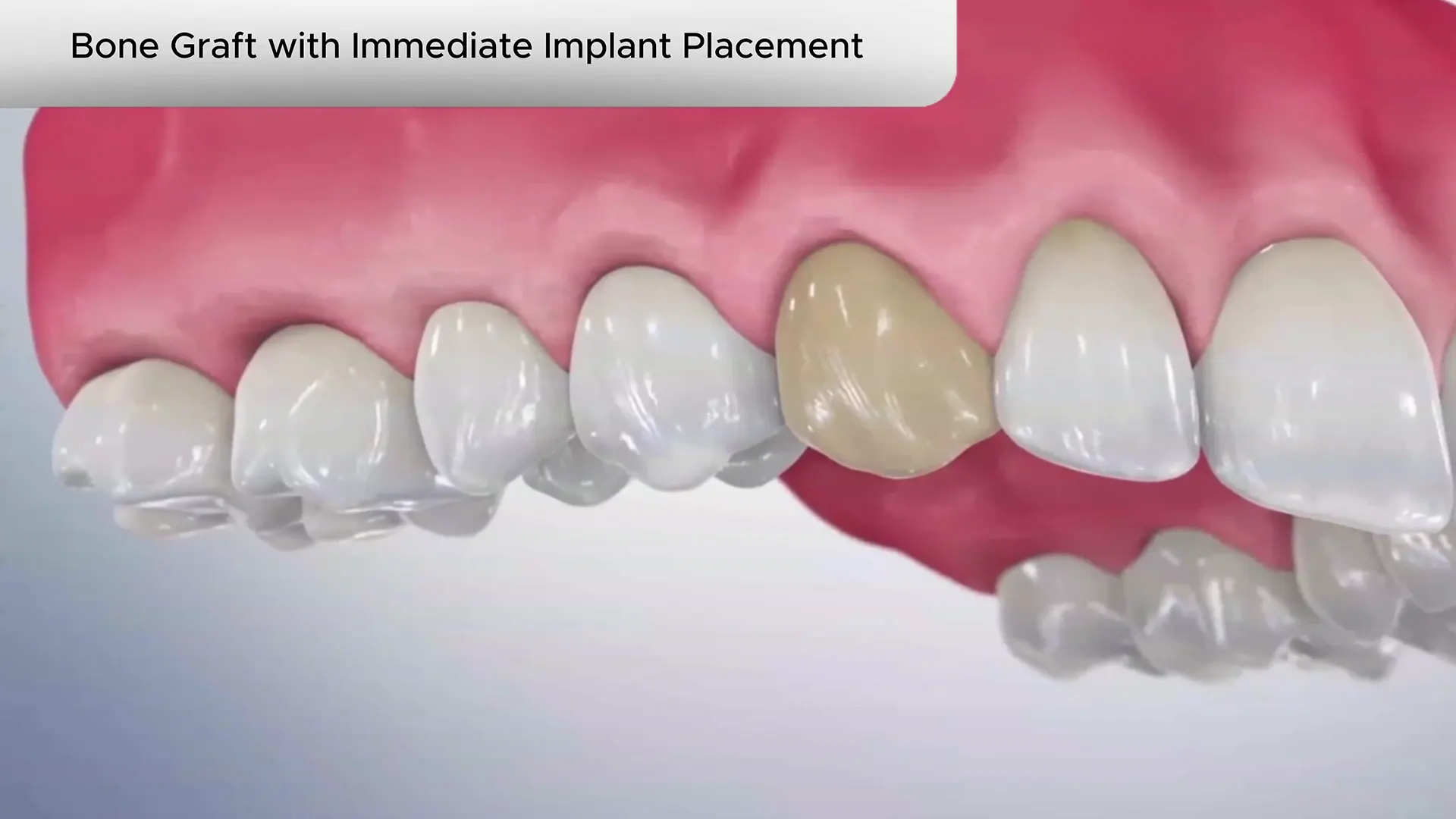 Bone_Graft_with_Immediate_Implant_Placement_Cover