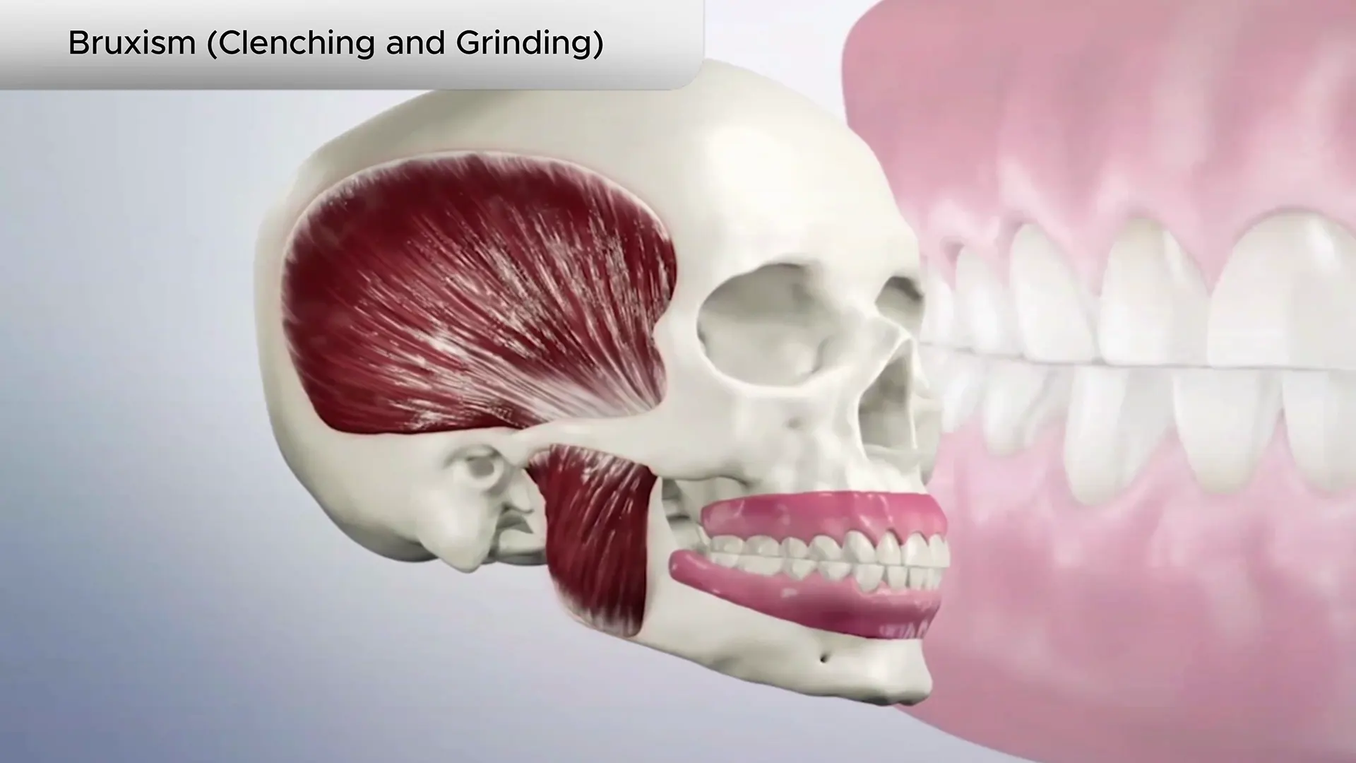 Bruxism (clenching_and_grinding) (2160p) Cover