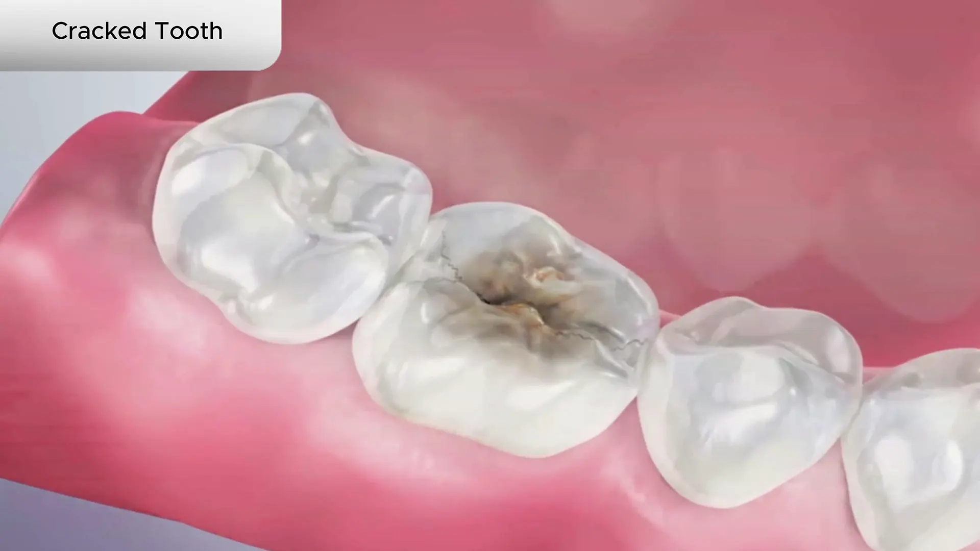 Cracked Tooth Cover
