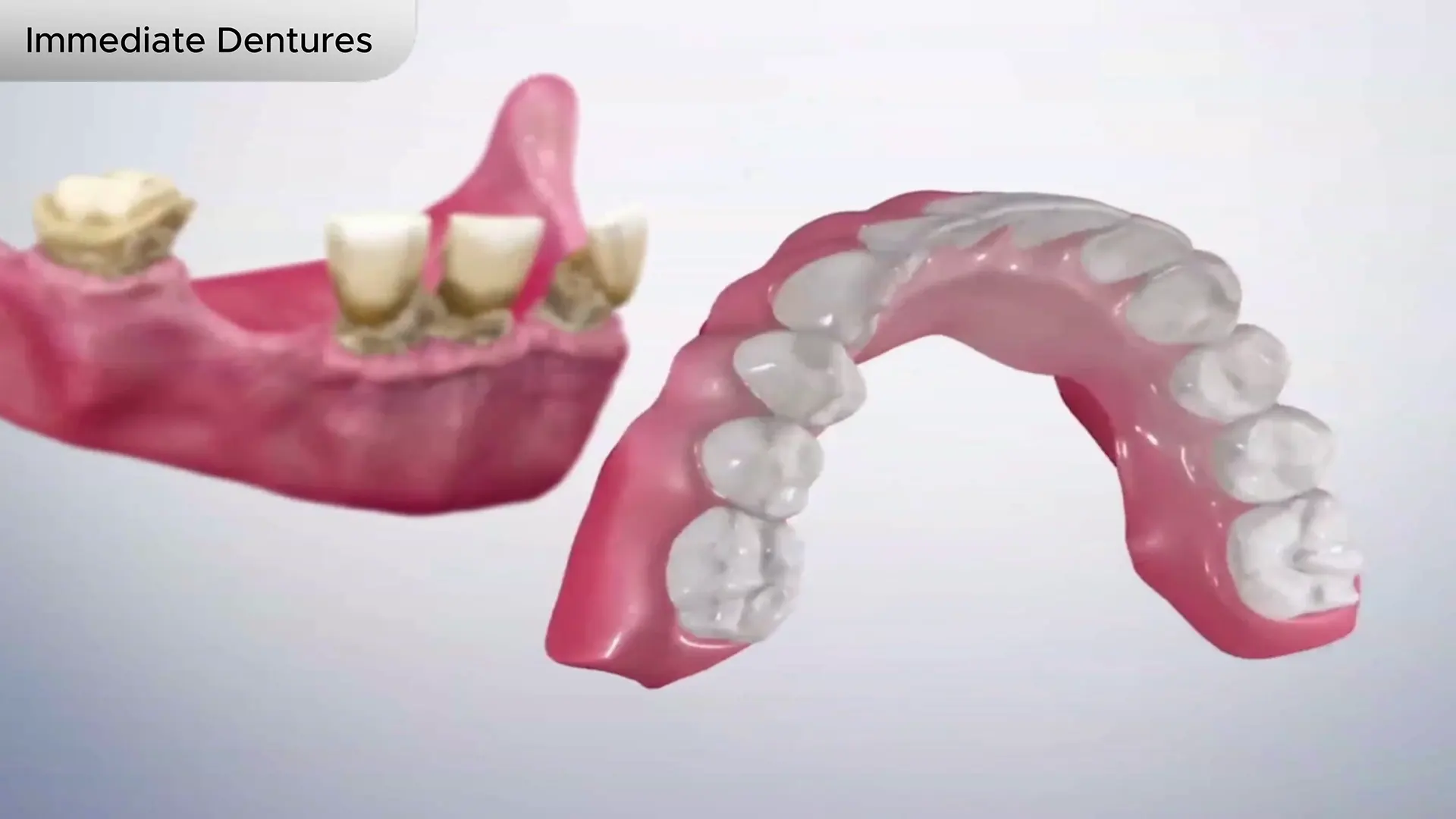 Immediate Dentures Cover