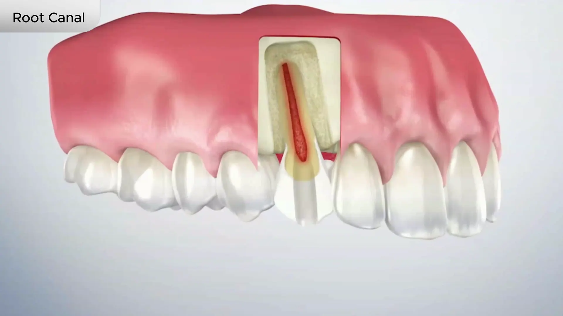Root Canal Cover