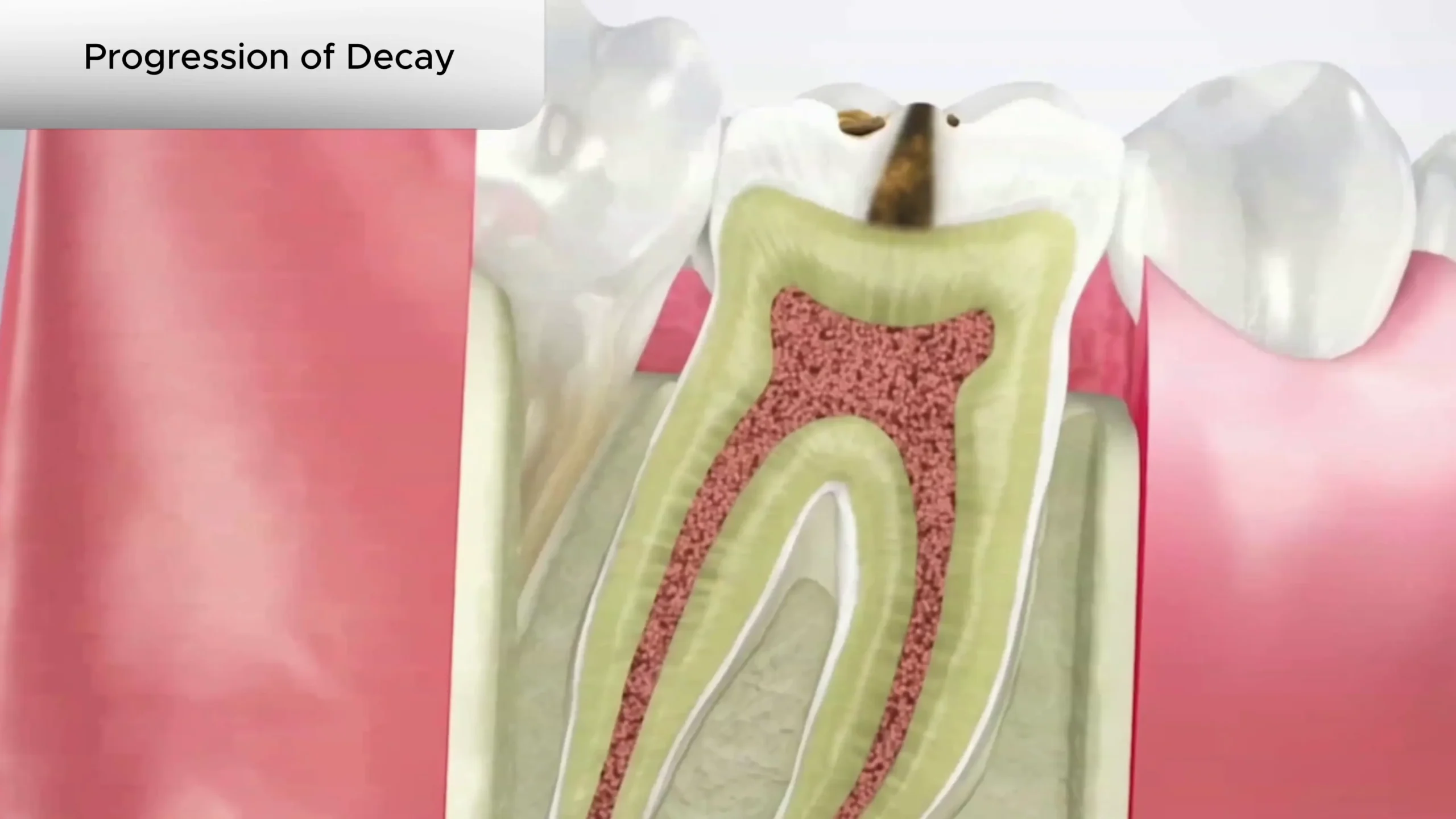 Tooth Decay Cover
