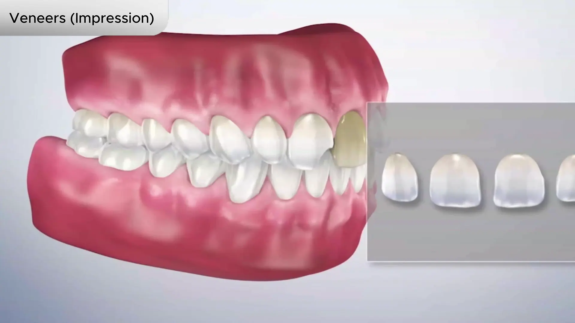Veneers (Impression) Cover