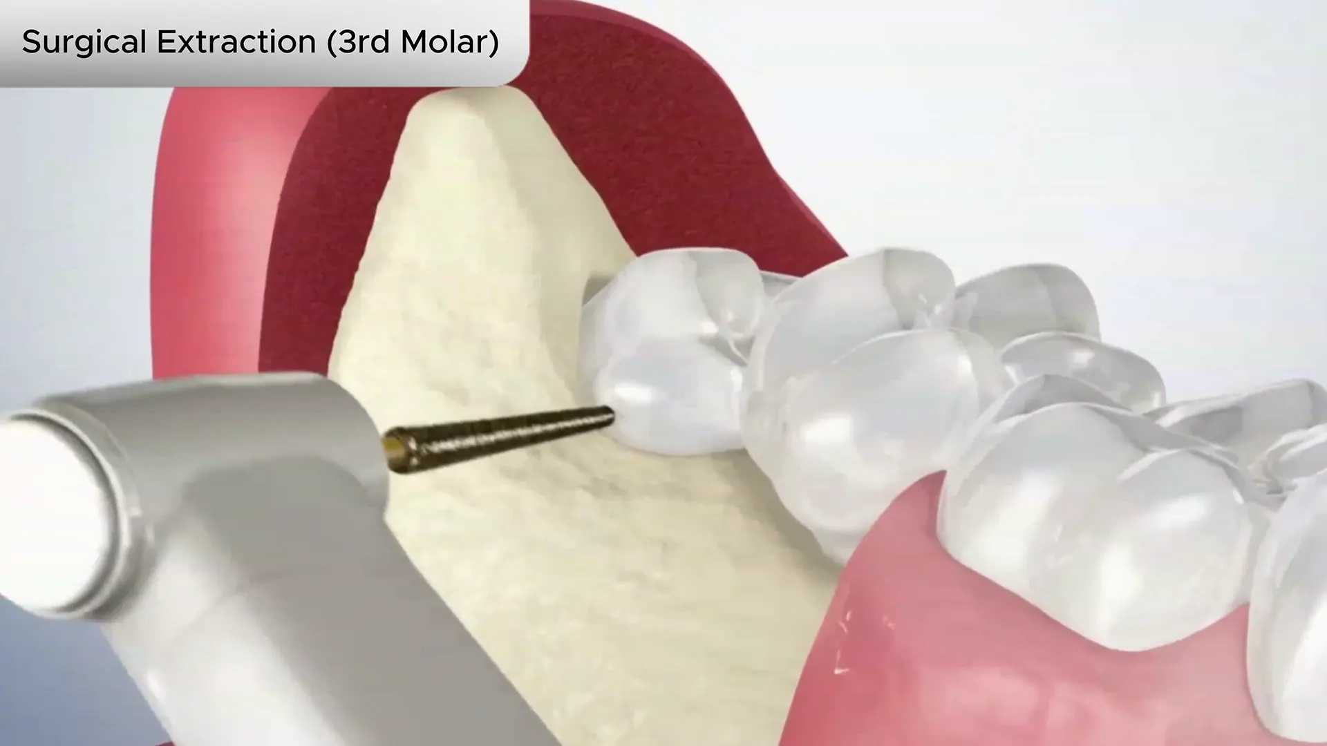 Wisdom Teeth Cover