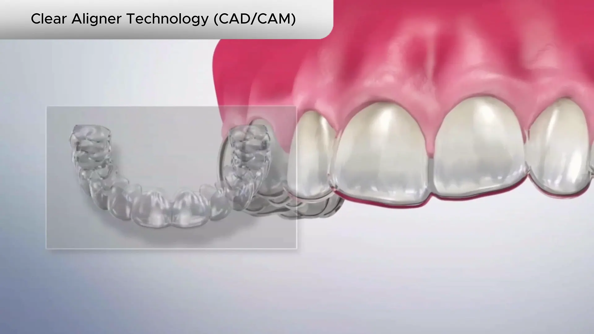 clear_aligner_technology cover