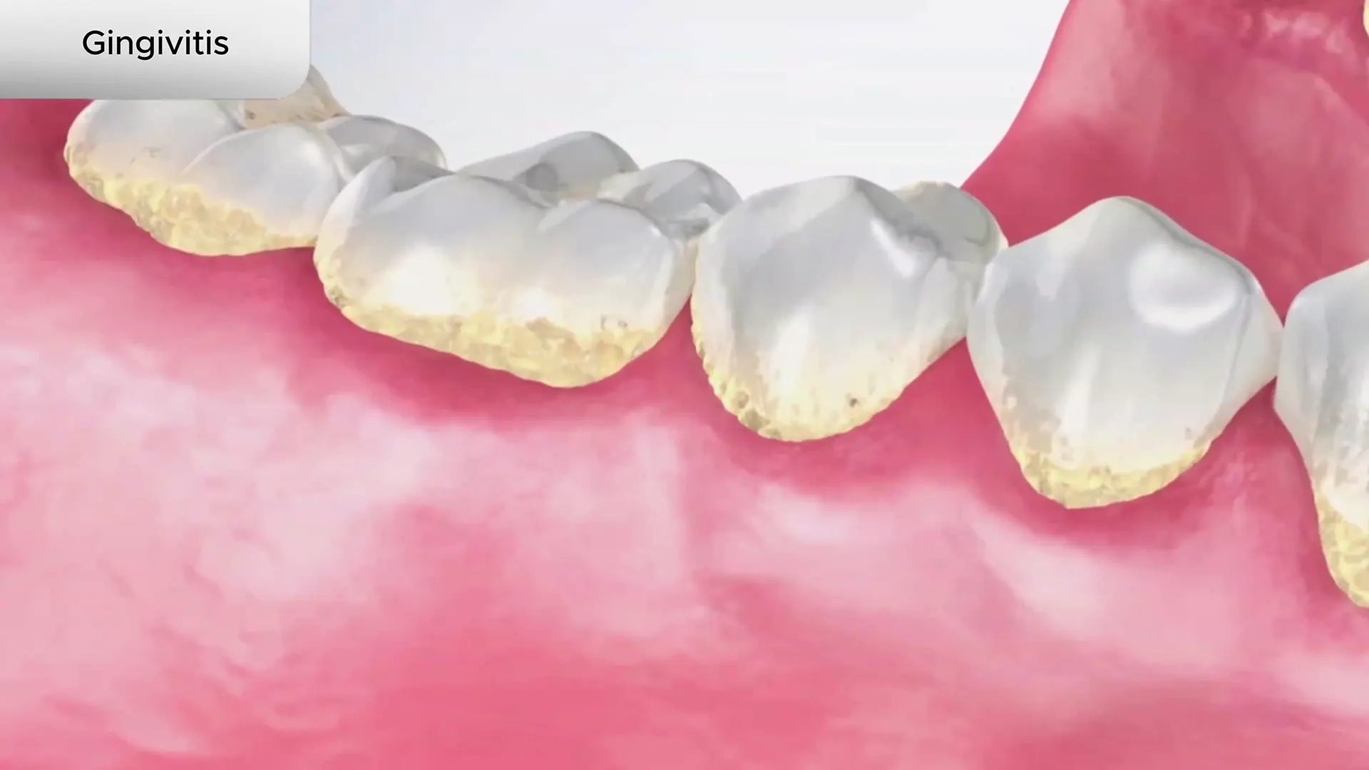 gingivitis cover