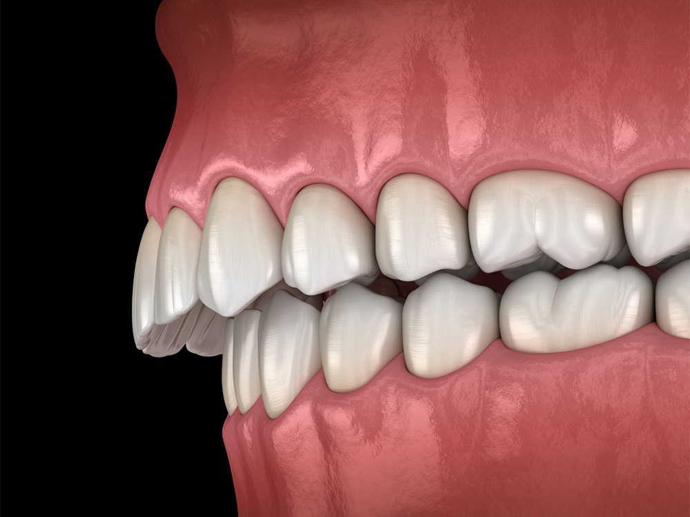 3D rendering of an overbite showing how the upper teeth overlap the lower teeth