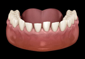 3D rendering of a spaced out upper dental arch showing teeth and gums