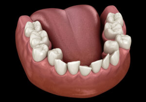 3D rendering of a crowded lower dental arch showing teeth and gums