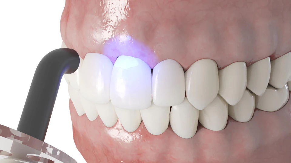 Dental bonding services available at Pathway Dental Group in Santa Barbara, CA