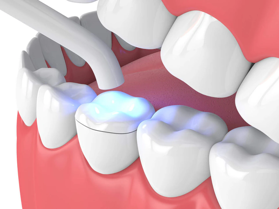 Dental onlay and dental inlay services available at Pathway Dental Group in Santa Barbara, CA