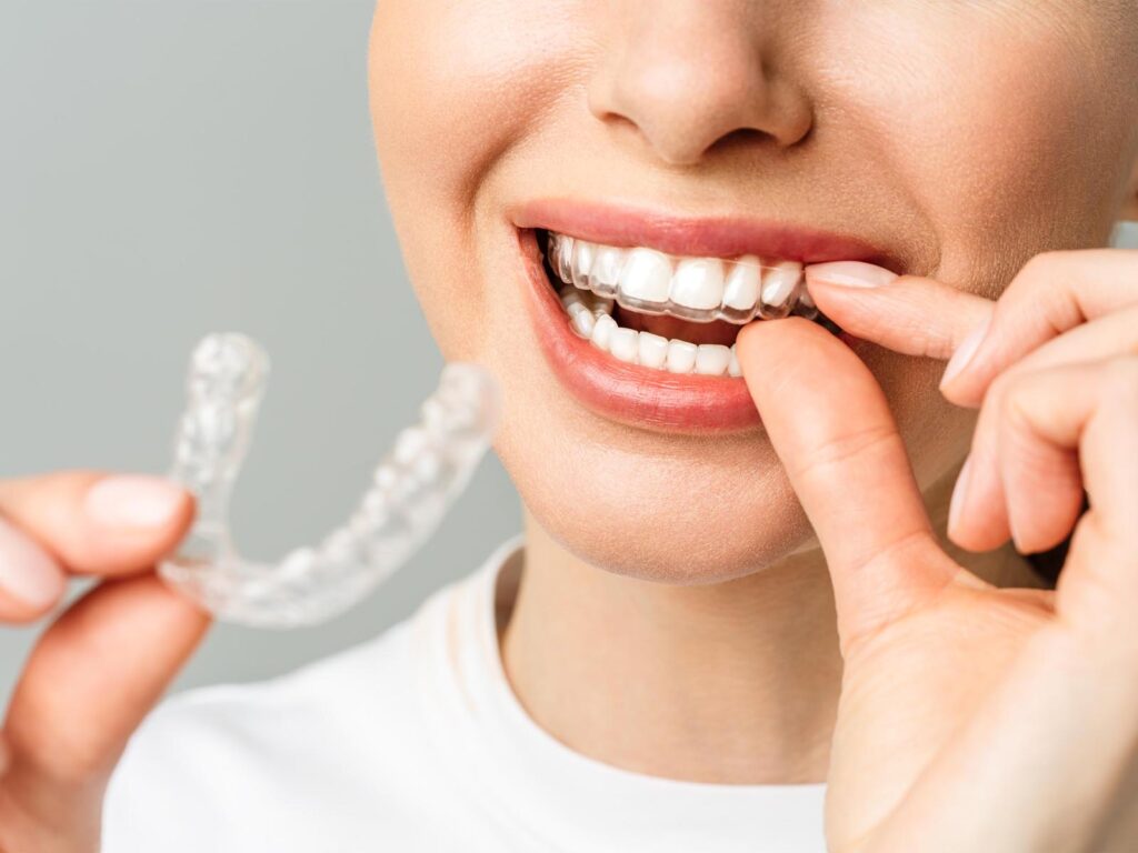 a woman puts Invisalign aligner over her teeth