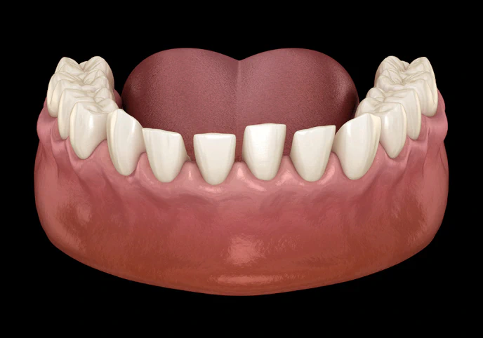 3D rendering of a spaced out upper dental arch showing teeth and gums