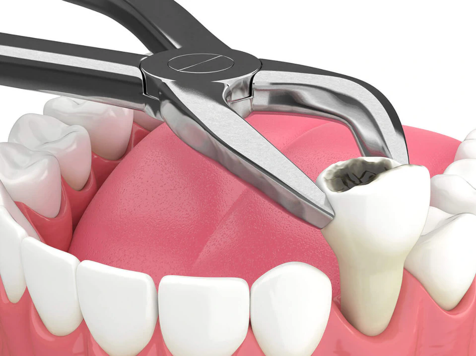 Tooth extraction services available at Pathway Dental Group in Santa Barbara, CA